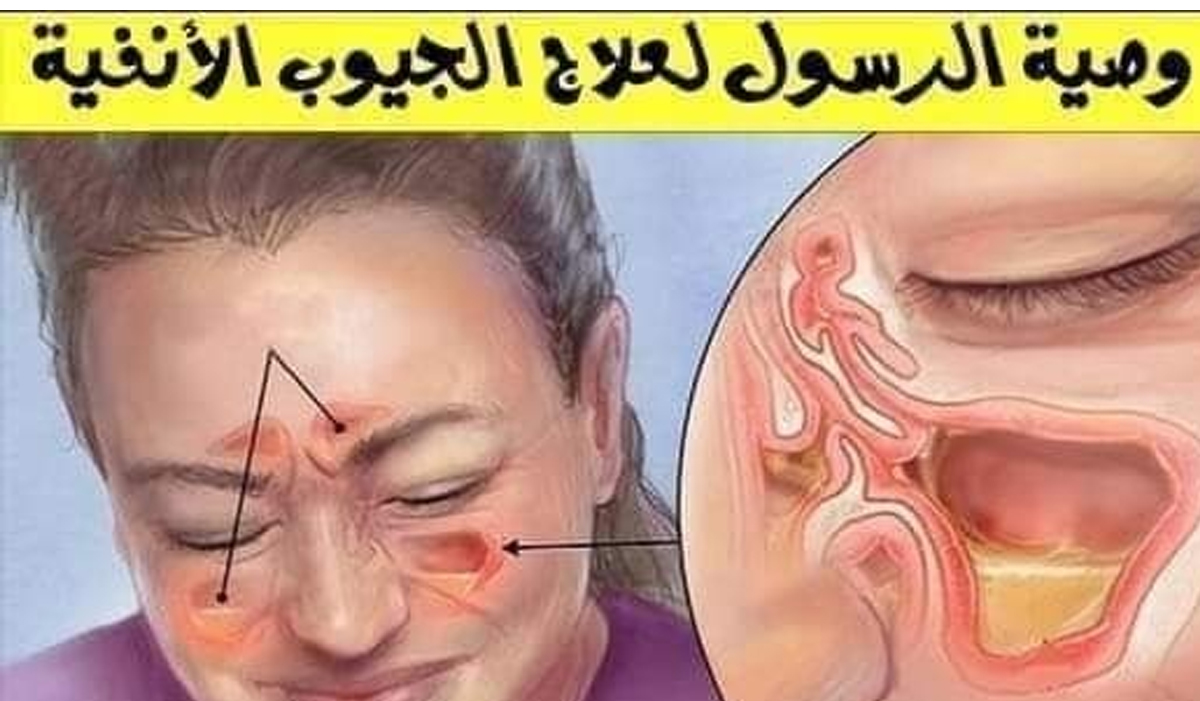دواء الجيوب الانفية